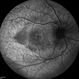 Cystoid Macular Edema (CME) Cystoid Macular Edema (CME)